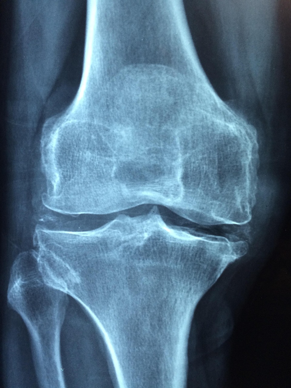 découvrez tout sur le cartilage de l'oreille : structure, fonction et conseils pour sa santé et son entretien.